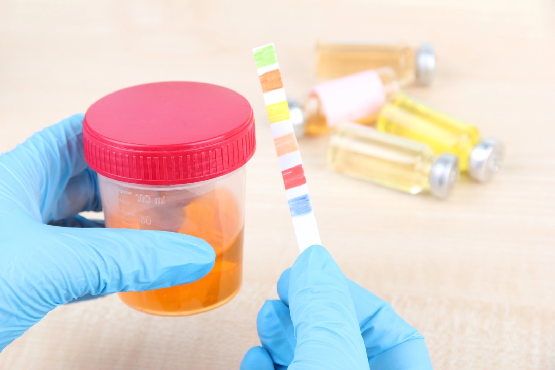 Urinalysis in progress—get fast, accurate results with the best STD testing Houston clinics for confidential care