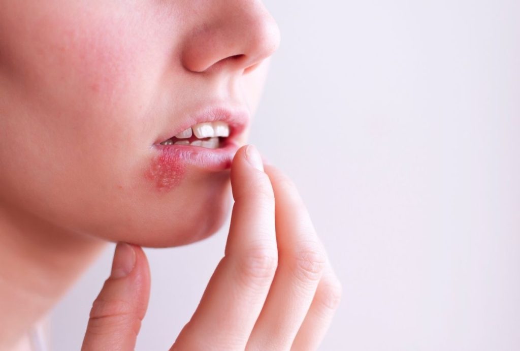 Close-up of lip lesion suggesting cold sore; patient touching area, highlighting confidential sti testing houston services