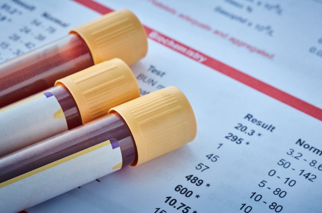 Close up of blood samples in a rack labeled for an STD test at a local center for professional std testing houston.